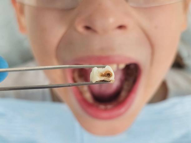 Best Cracked Tooth Emergency Dentist  in Battle Ground, IN